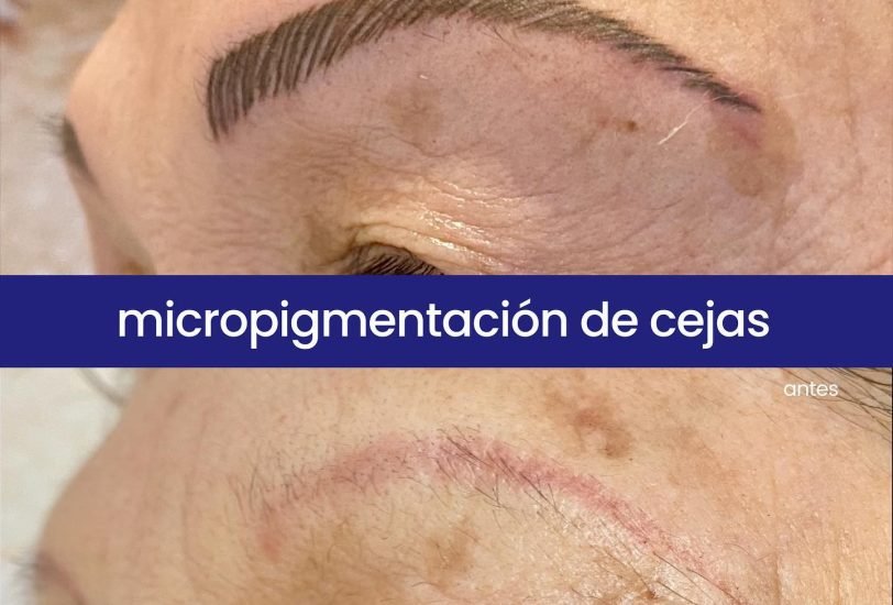 Eye Rejuvenation