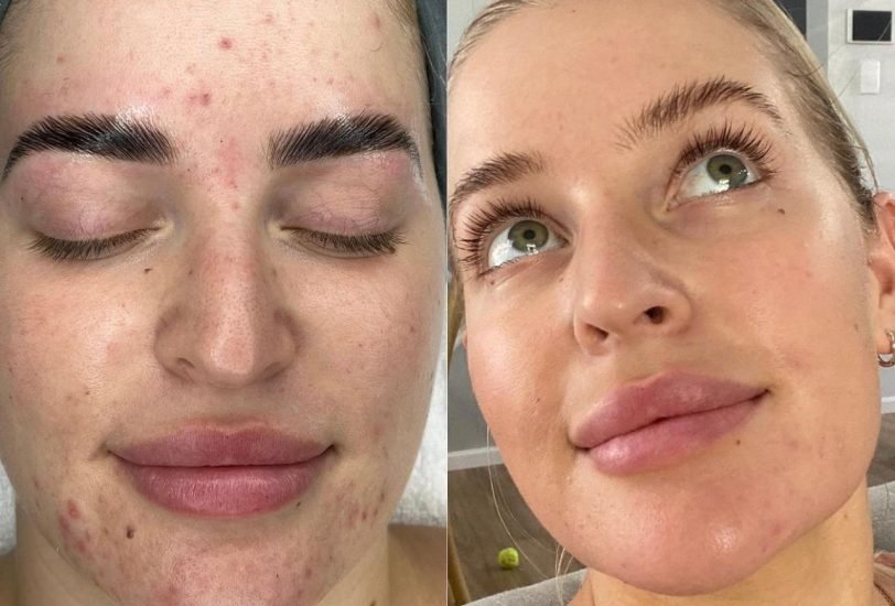 Acne & Scar Treatments