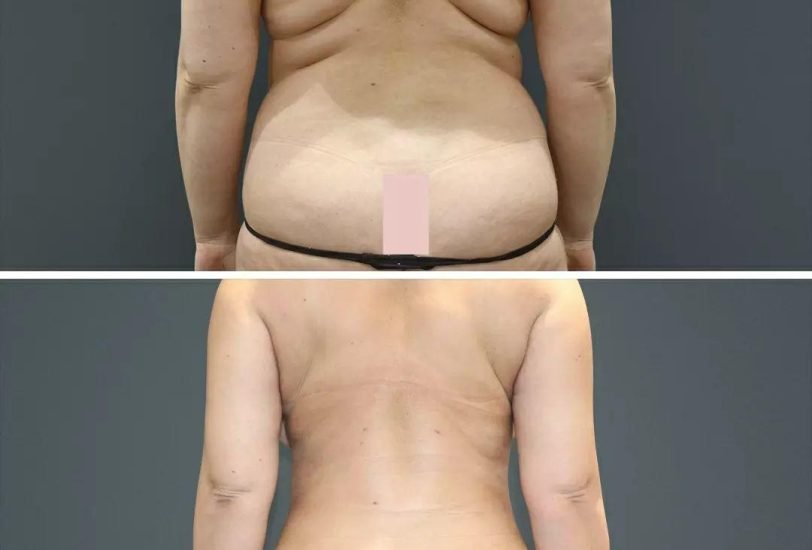 Fat Transfer