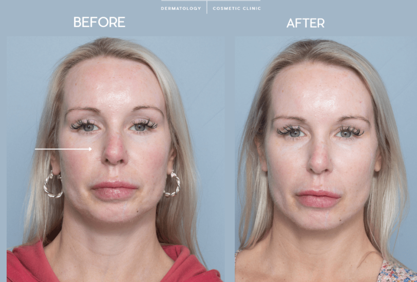 Skin Rejuvenation