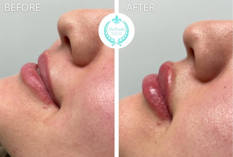 Dr Fresh 4 – VerifiedCare Lips Treatments