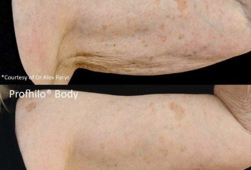 Body Contouring