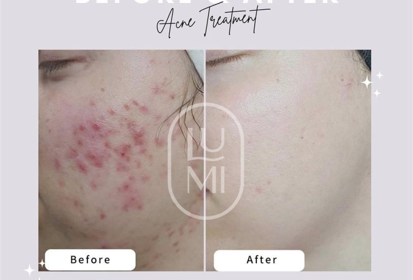 Acne & Scar Treatments