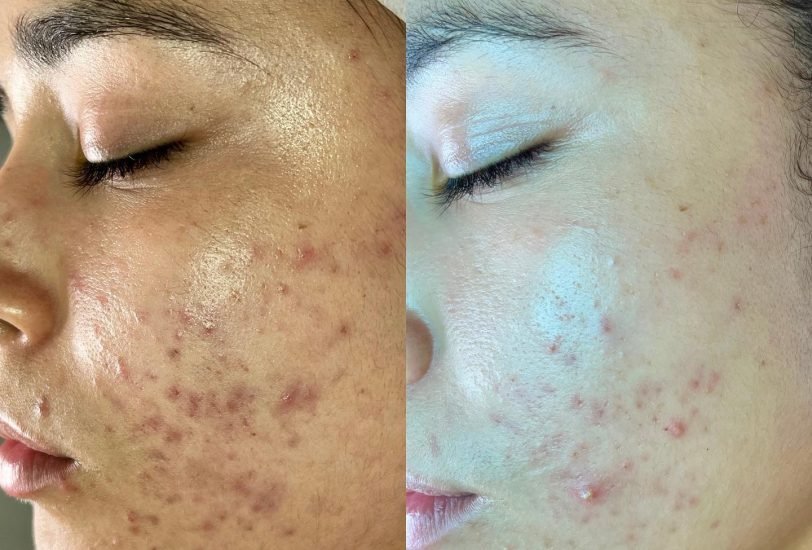 Boston Skincare 4 – VerifiedCare Acne & Scar Treatments