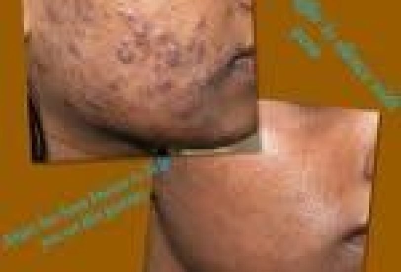 Acne & Scar Treatments