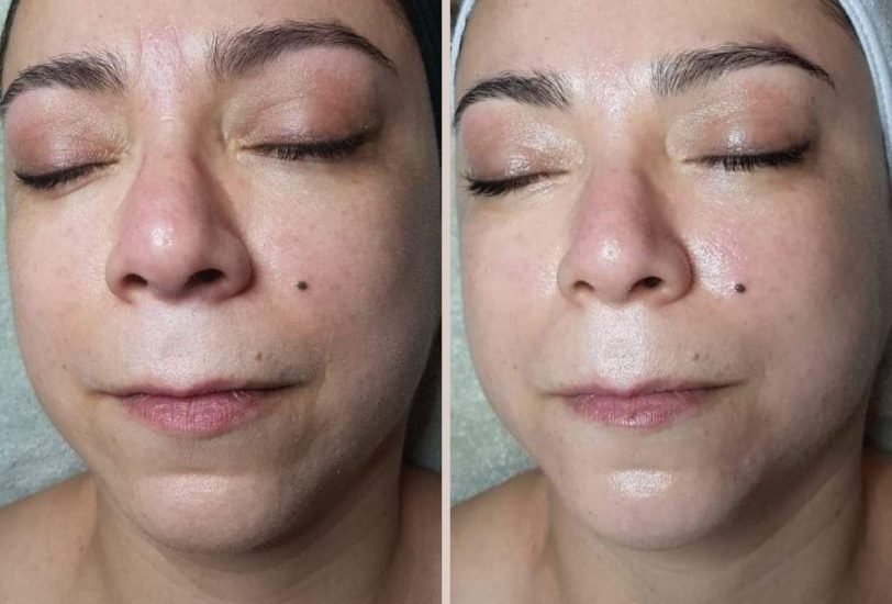 Skin Rejuvenation