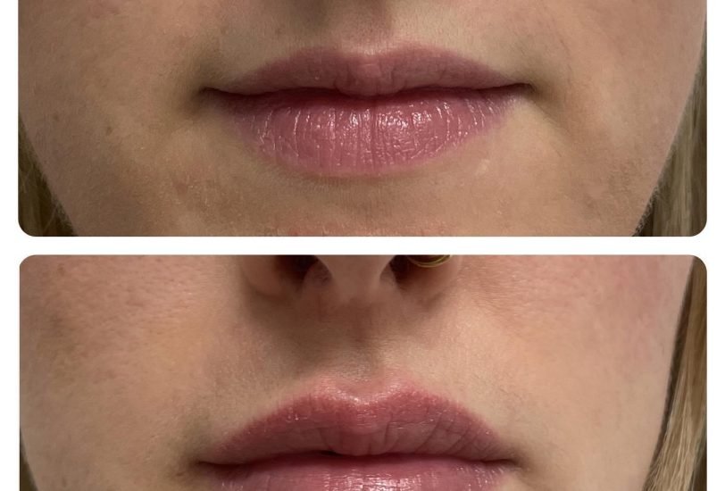Lips Treatments