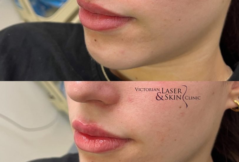 Lips Treatments
