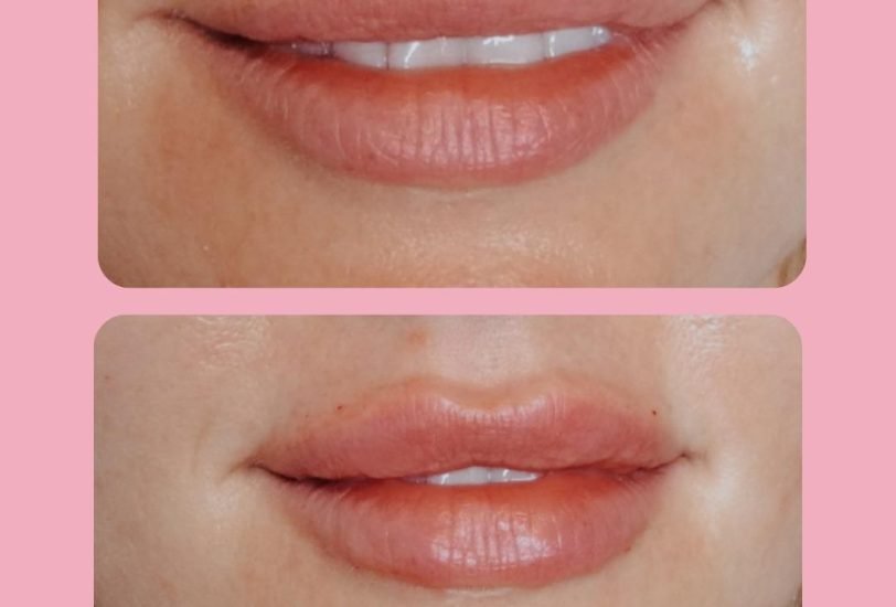 Lips Treatments