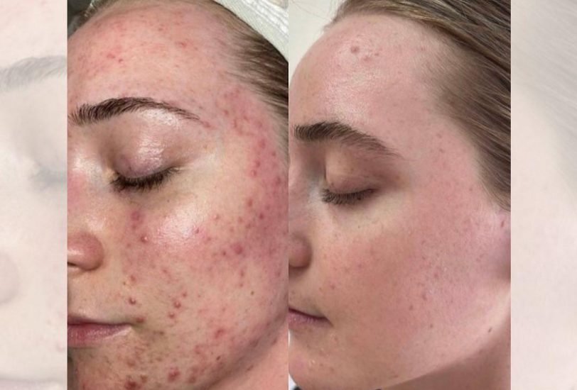 Acne & Scar Treatments