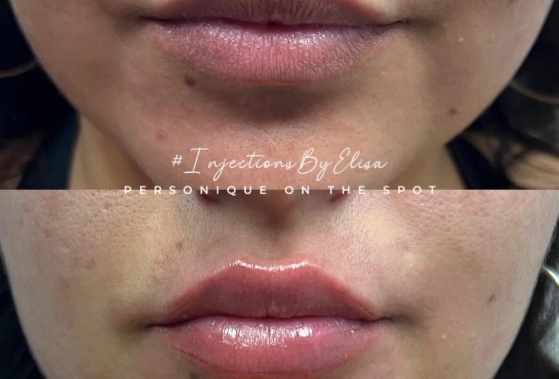 Lips Treatments