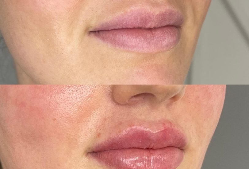 Lips Treatments