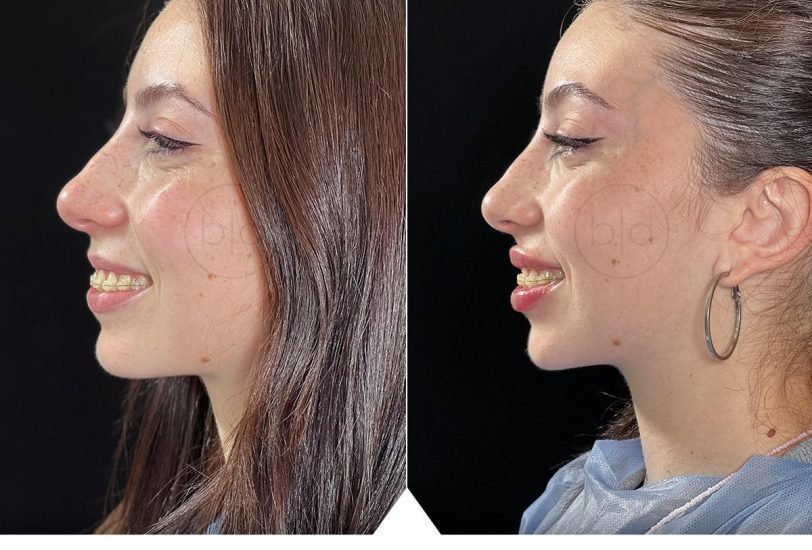 Double Chin & Jawline Contouring