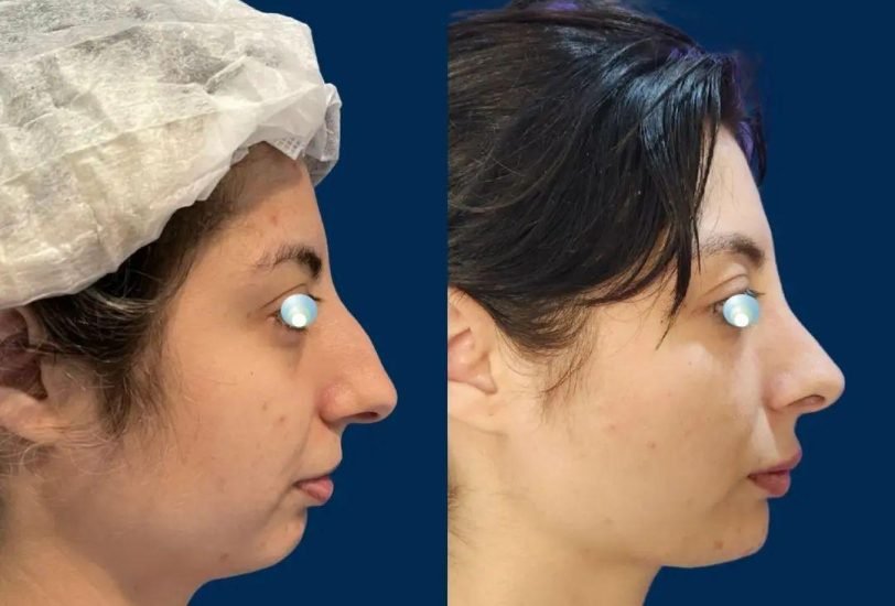 Double Chin & Jawline Contouring
