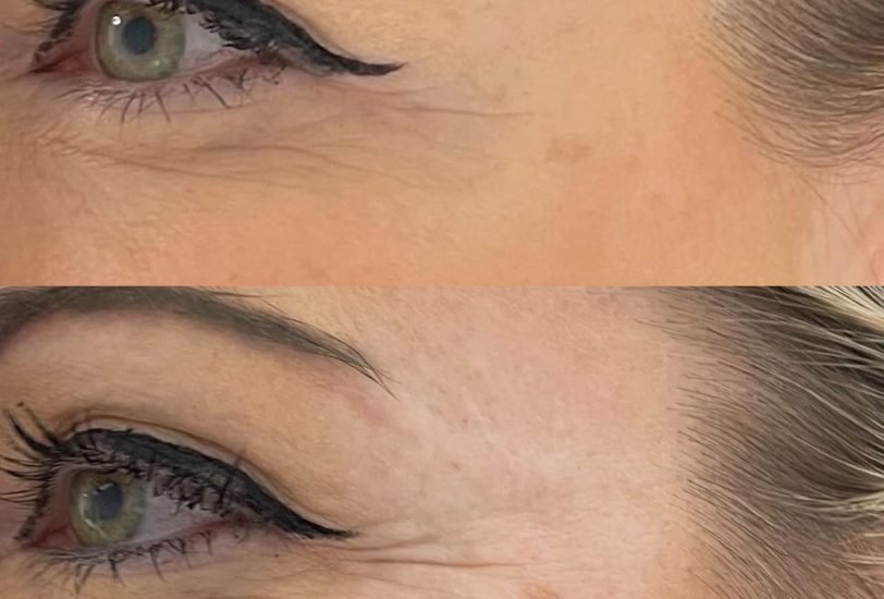 Eye Rejuvenation