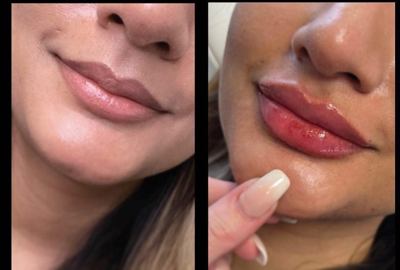 Lips Treatments