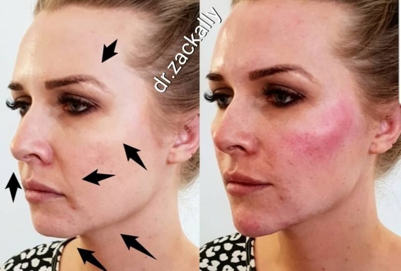 Facial Contouring & Lifting