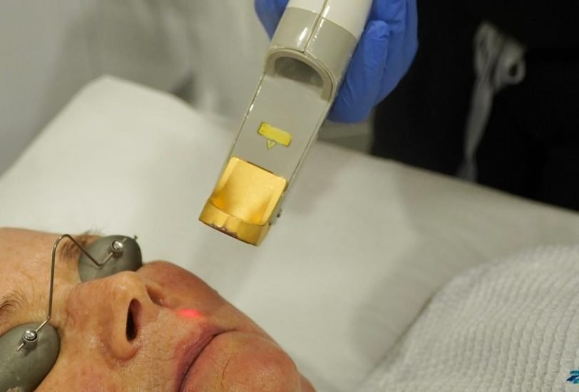 Laser Hair Removal