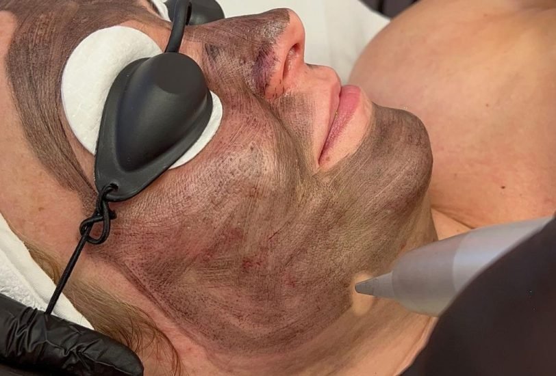 Laser Hair Removal