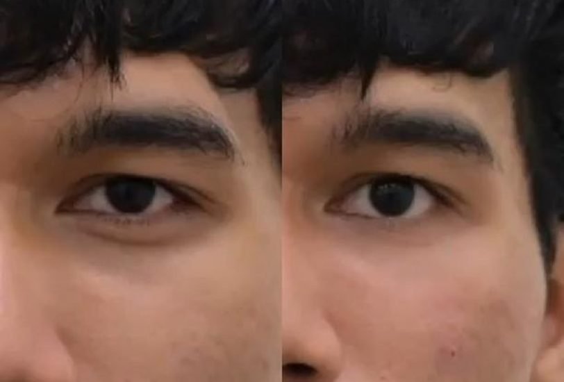 Eye Rejuvenation