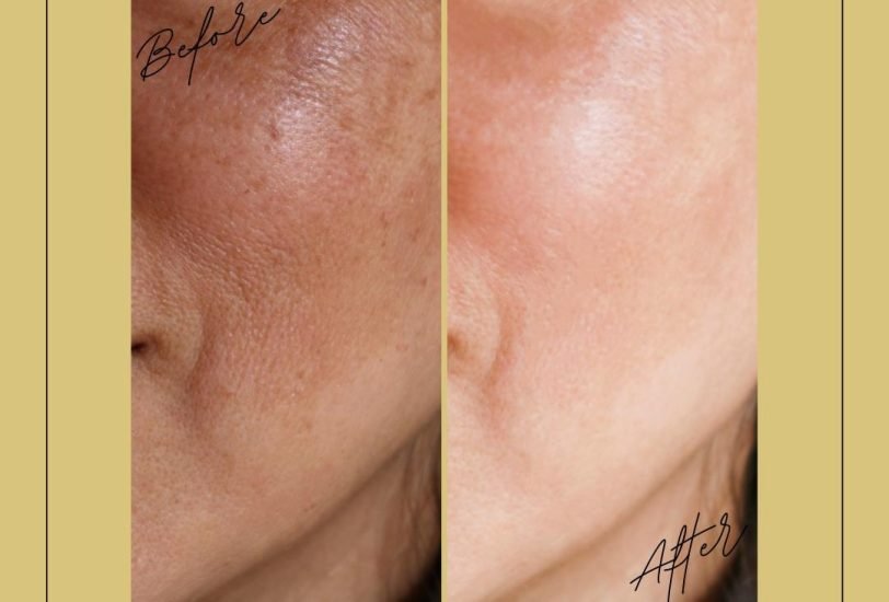 Acne & Scar Treatments