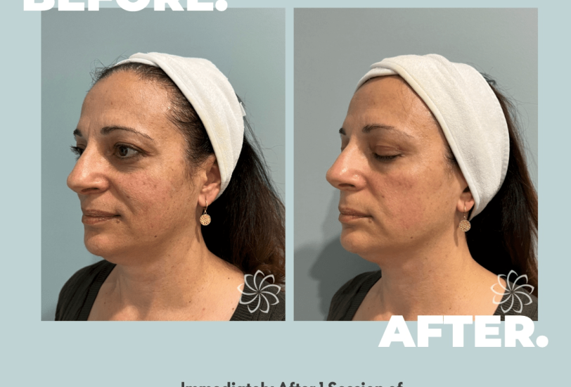 Skin Rejuvenation (Chemical Peels, Facials)
