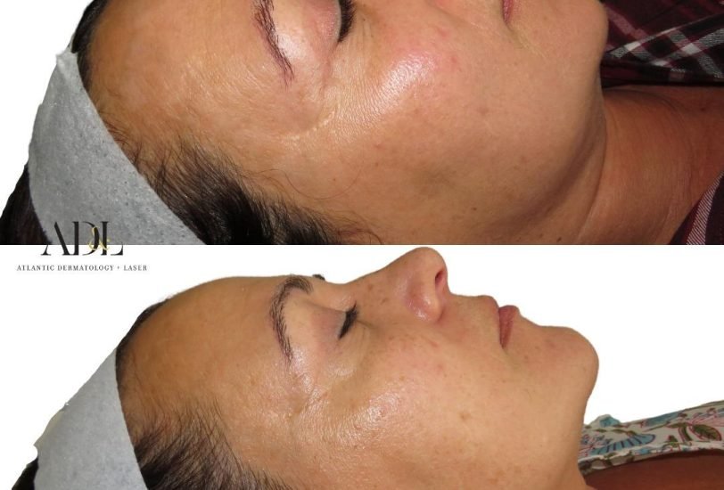 Acne & Scar Treatments