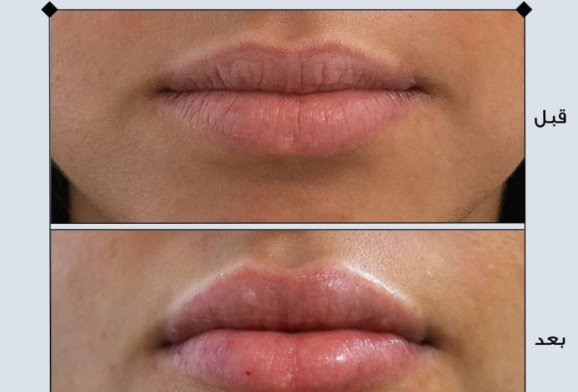 Lips Treatments