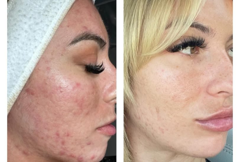 Acne & Scar Treatments
