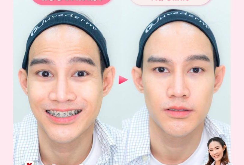 Double Chin & Jawline Contouring