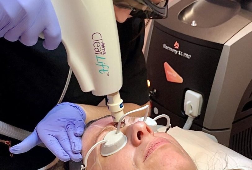 Laser Hair Removal