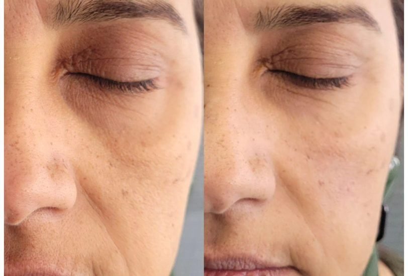 Anti-Aging Treatments
