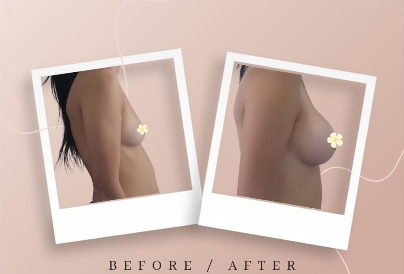 Breast Augmentation