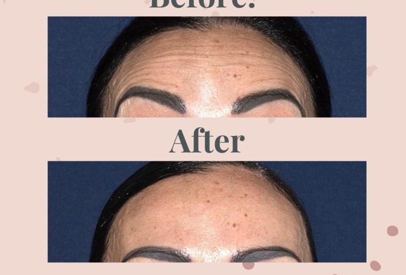 Skin Rejuvenation