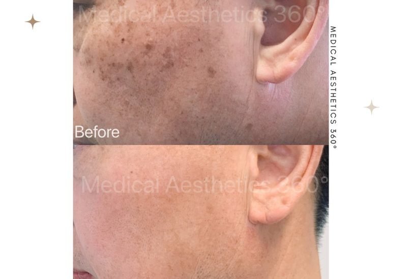 Acne & Scar Treatments