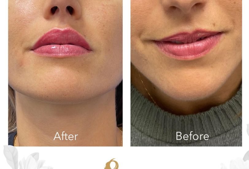Lips Treatments