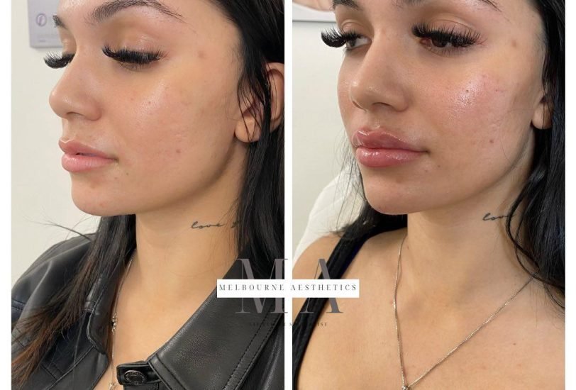 Injectable Treatments
