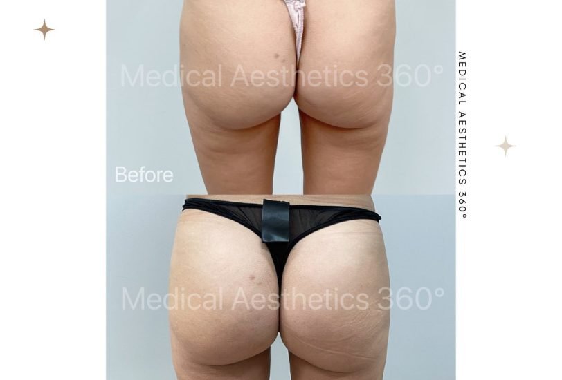 Non-Surgical Butt Lift