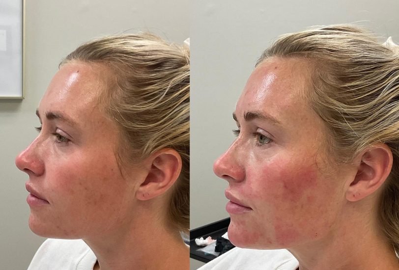 Facial Contouring & Lifting