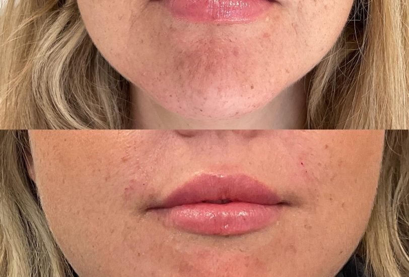 Acne & Scar Treatments