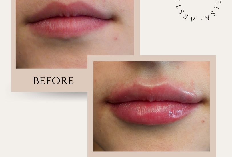Lips Treatments