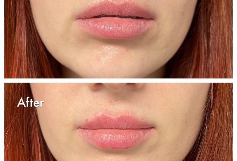 Lips Treatments