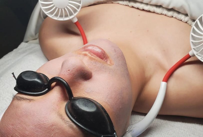 Laser Hair Removal