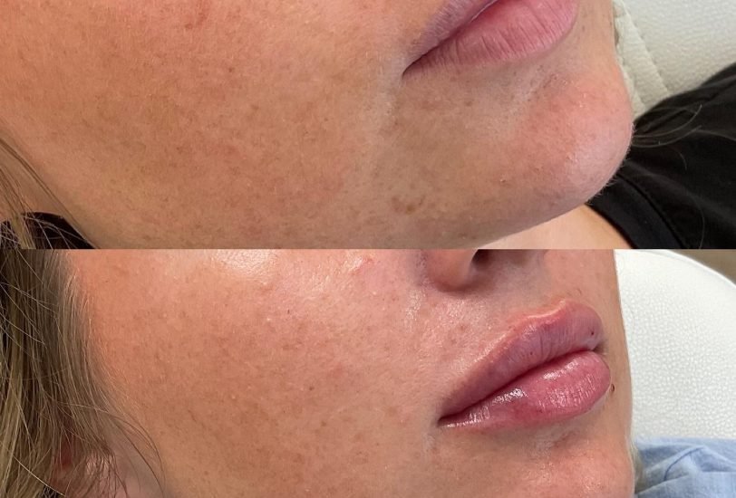 Skin Rejuvenation
