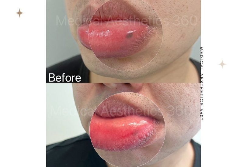 Lips Treatments