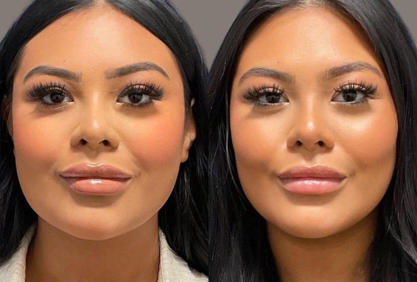 Facial Contouring & Lifting
