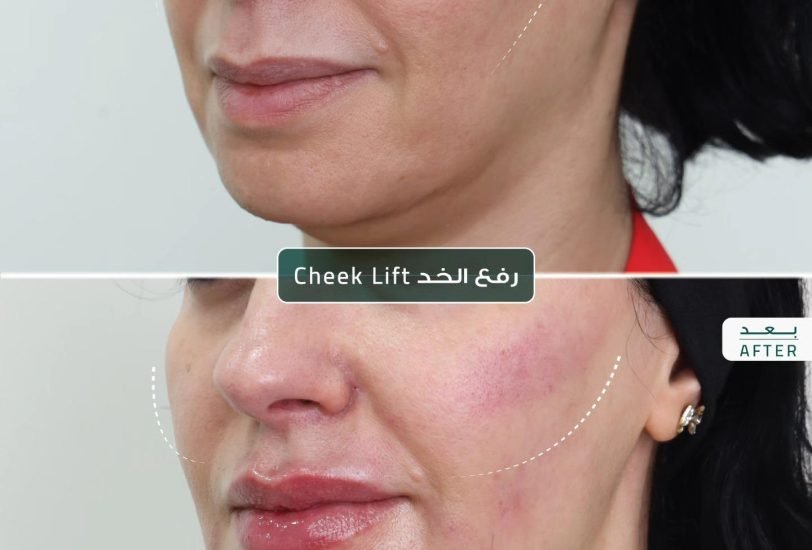 Skin Tightening