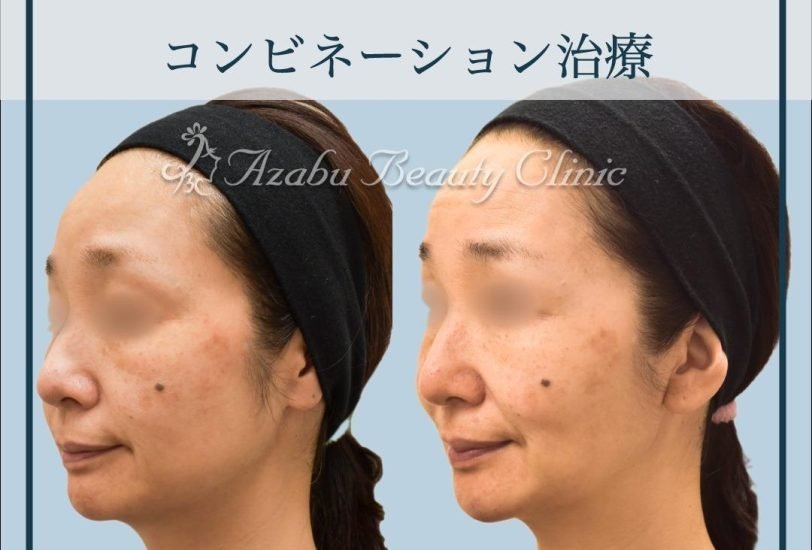 Facial Contouring & Lifting