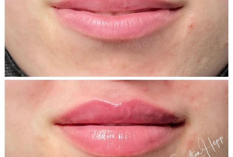Lips Treatments