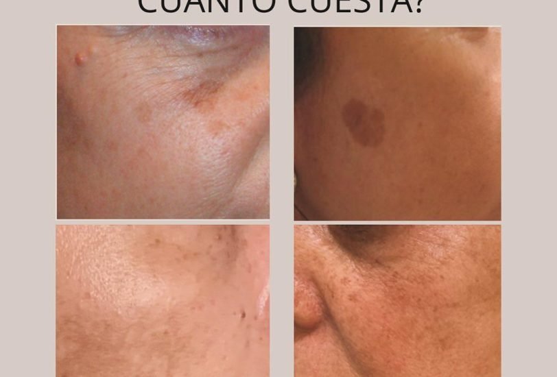 Scar Revision Treatments